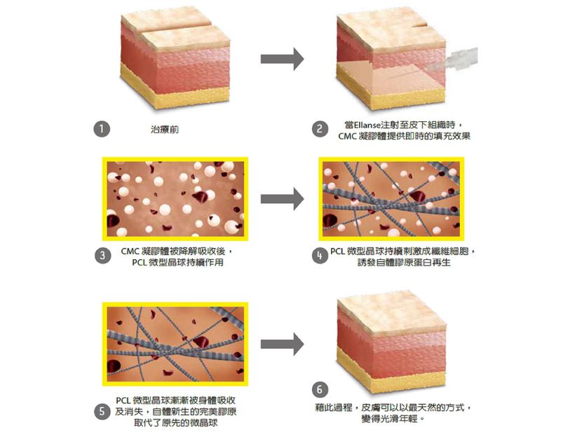 Ellanse 洢莲丝有哪些优点？Ellanse 洢莲丝保持时间是多久？