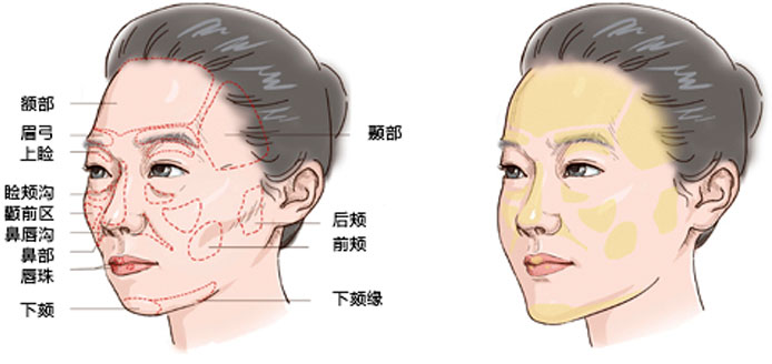 自体脂肪填充额头怎么样？精微自体脂肪移植有哪些优点？