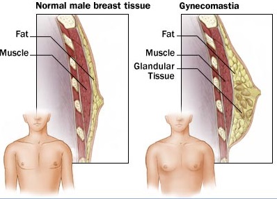男性女乳症的症状有哪些？怎么治疗？