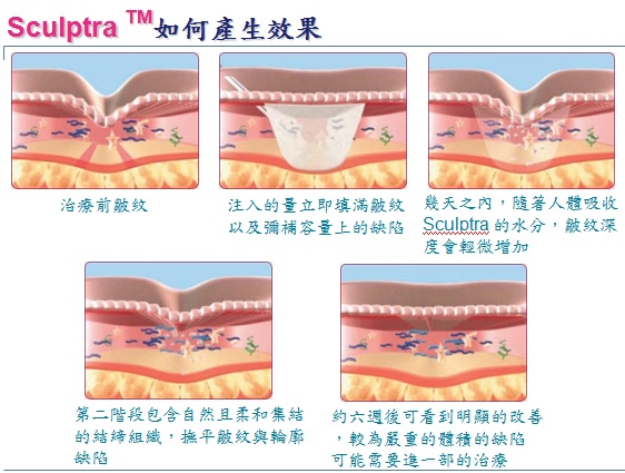 Sculptra舒颜萃注射作用原理优点有哪些？