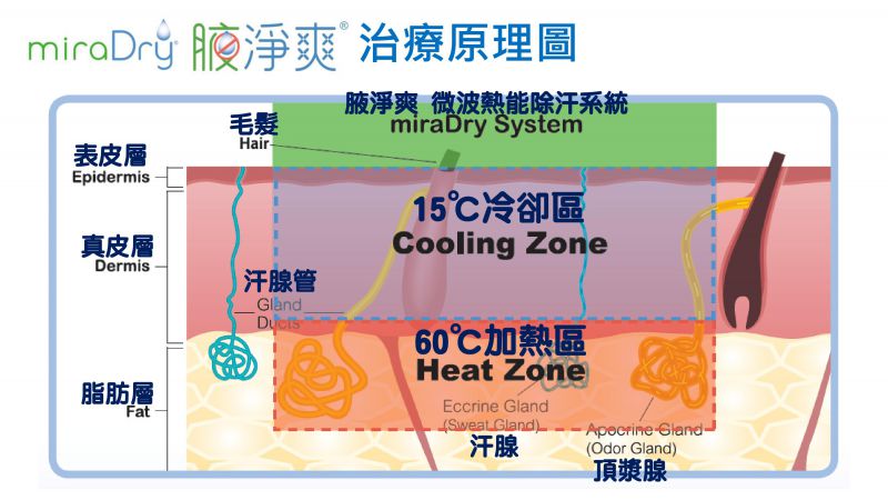 miraDry腋净爽治疗后可以持续多久？是永久的吗？恢复期？