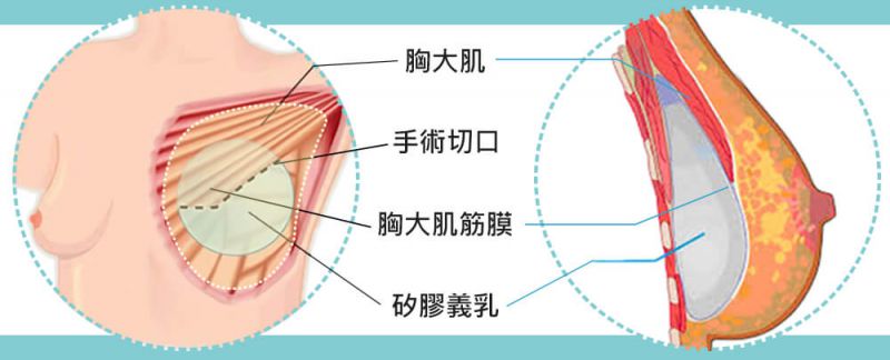 内视镜隆胸的疤痕在哪里？需要贴美容胶吗？