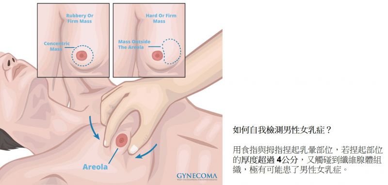 男性女乳症手术的恢复期多久？男性女乳副作用后遗症有哪些？