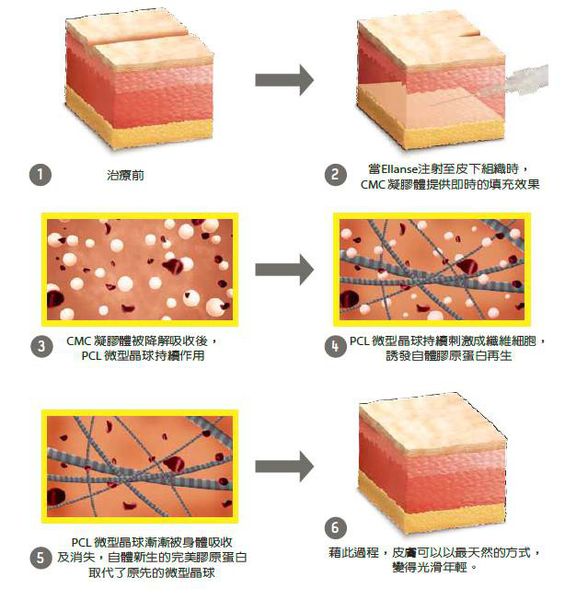 洢莲丝Ellanse效果好吗？哪些人适合洢莲丝Ellanse？注意事项？