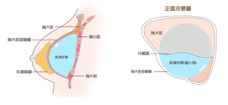 为什么隆胸要使用内视镜？内窥镜丰胸会不会有疤痕？