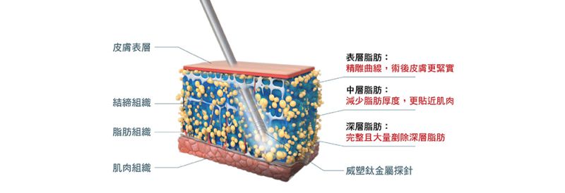 做完威塑抽脂后皮肤会不会松弛？威塑抽取的脂肪可以做脂肪填充吗？