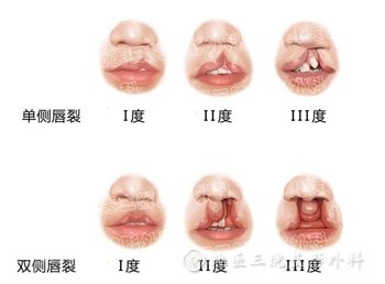 先天性唇裂能一次性解决问题吗？先天性唇裂常见知识