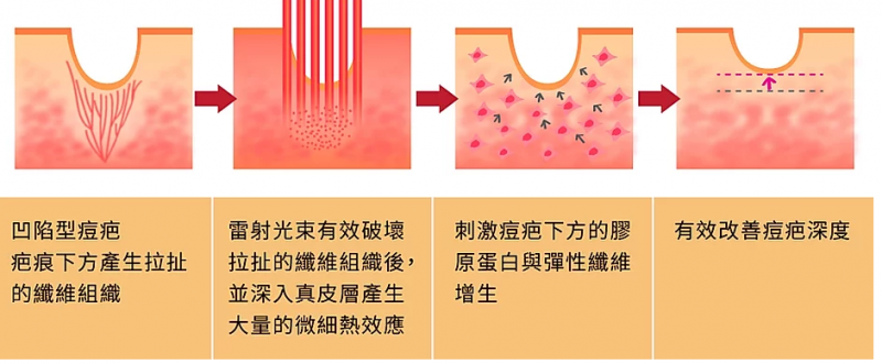 毛孔粗大的困扰，我可以做什么改善呢?ECO2飞梭雷射很痛吗？