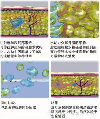 水动力辅助吸脂(WAL)相对于传统吸脂有哪些优点？