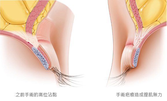 什么样的情况需要二次眼修复手术呢？