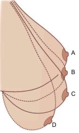 经乳晕提乳手术有什么优缺点？提乳手术方法有哪些切口？