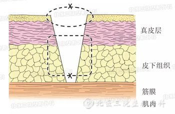 整形美容缝合后需要拆线吗？整容后几天拆线？