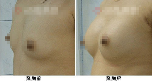 乳房重建发炎或者感染怎么办？硅胶注射乳房是否会致癌？