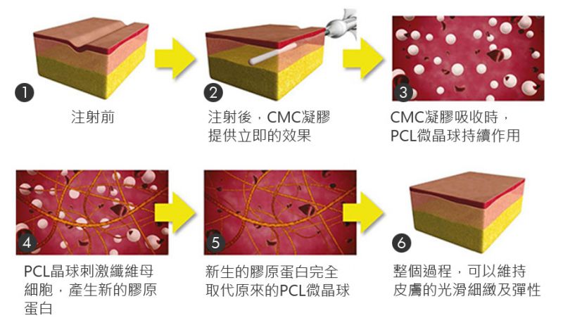 洢莲丝疗程有哪些优点？可以解决肌肤凹陷及皱纹吗？