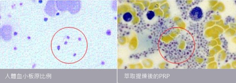 自体脂肪丰胸果冻硅胶隆胸盐水袋丰胸哪个好？全方面对比表