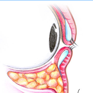 眼袋内开合并脂肪移位手术适合哪些人？