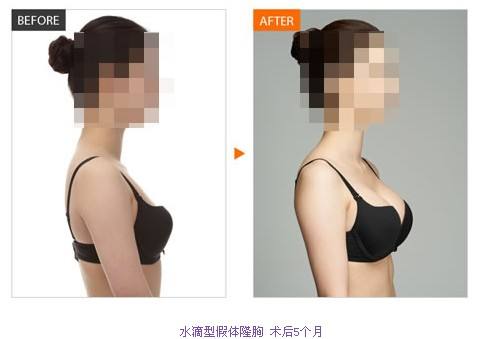 隆胸手术后可以正常哺乳吗？隆胸后遗症副作用术后事项