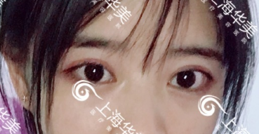 上海华美杨亚益和佀同帅哪个好做双眼皮？