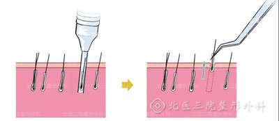 眉毛稀疏怎么办？哪些人适合植眉？植眉后注意什么？