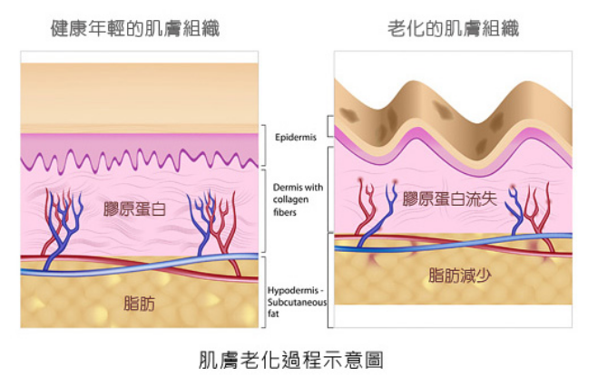 哪些部位做电波拉皮效果好？电波拉皮注意事项和事后护理