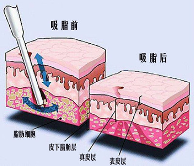 成都面部抽脂哪个医生好？成都脸部吸脂谁好？