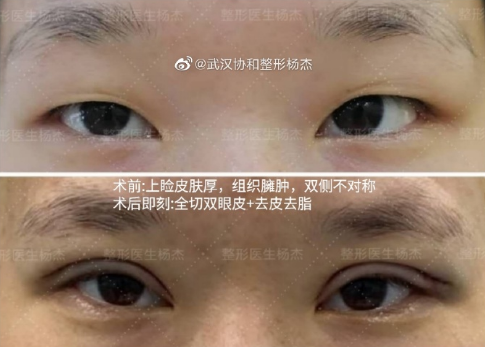 武汉协和杨杰割双眼皮怎么样？杨杰简介案例预约