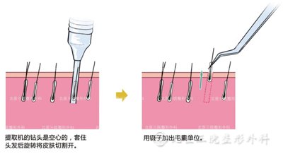 植发手术会留疤痕吗？植发移植的成活率高吗?