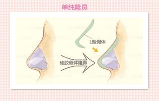 隆鼻后出现鼻穿孔是怎么回事？隆鼻鼻穿孔怎么修复？