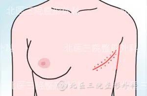 乳房再造会影响乳腺癌的治疗吗?乳房再造常见问题解答