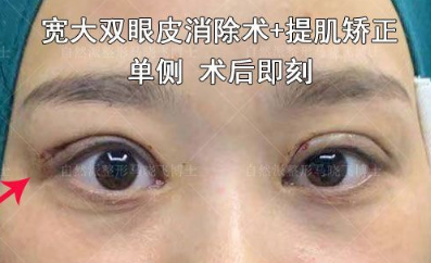 马晓飞修复双眼皮怎么样？马晓飞做眼修复好吗？