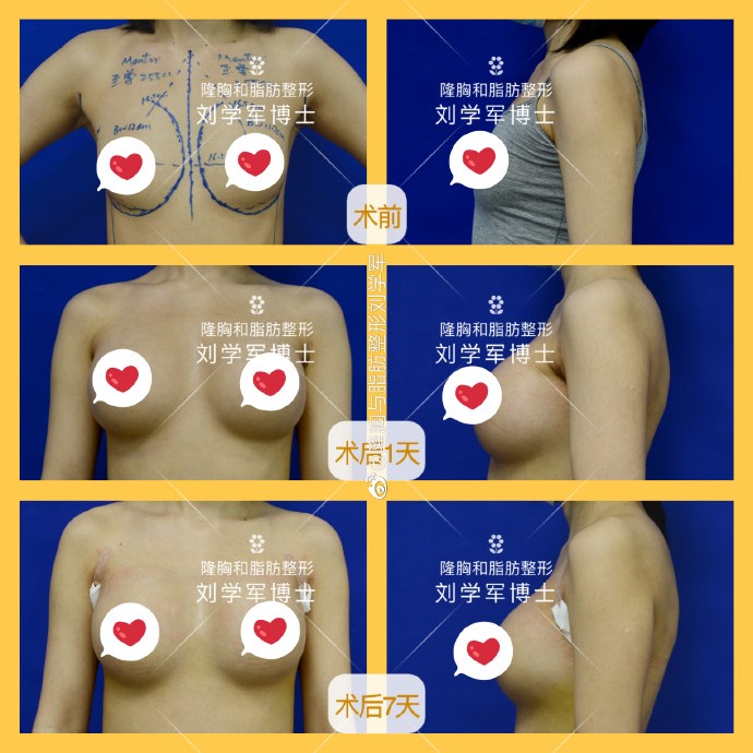 刘学军假体丰胸案例