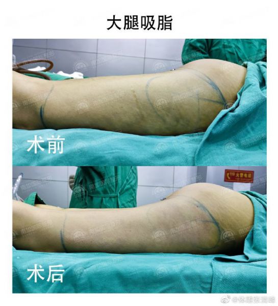 张清峰医生大腿吸脂技术怎么样？张清峰简介预约