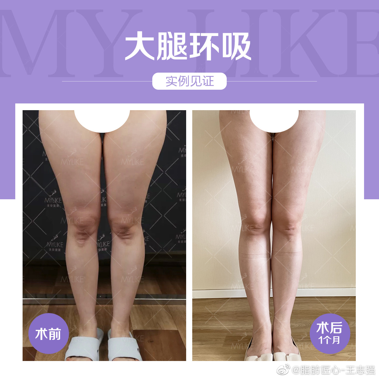 王志强大腿环吸案例