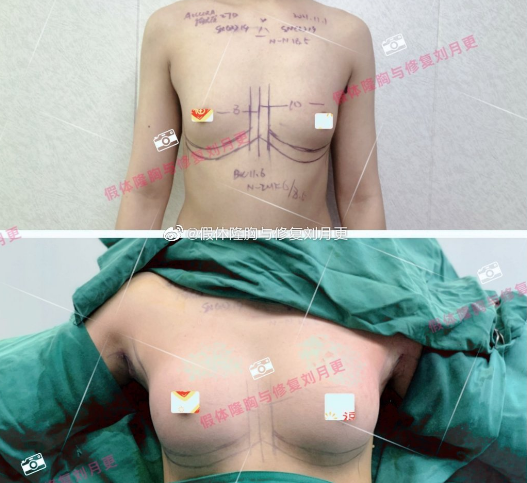 深圳刘月更丰胸隆胸技术怎么样？