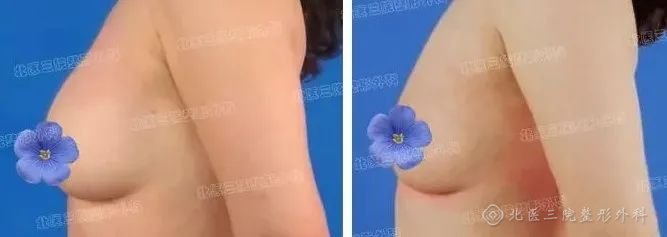 胸部奥美定取出后乳房形态怎么修复?