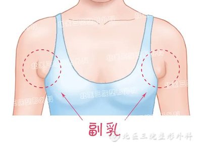 有副乳怎么办？副乳需不需要切除?