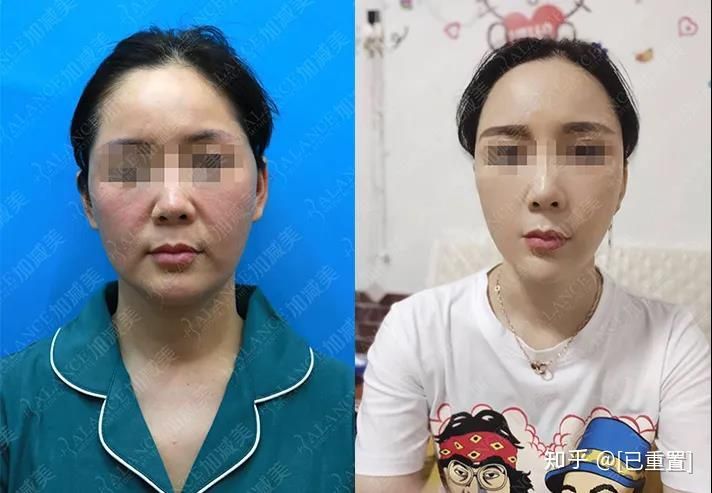 加减美穆宝安：V美减龄面部提升适合40岁的人做吗？