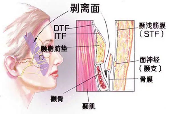 中下面部提拉术是小切口提升吗？