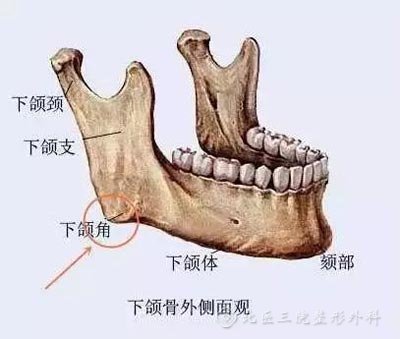 下颌角切除后会造成“面部垮塌”吗?