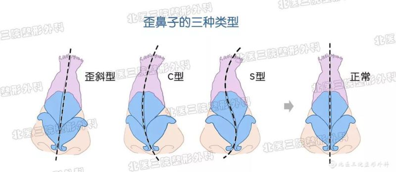 歪鼻会带来哪些危害？那鼻子歪了怎么办？