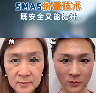 smas面部提升案例