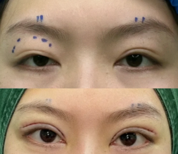 上海眼修复医生马娟和郑小红哪个医生做双眼皮修复好?