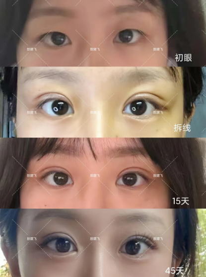 北京双眼皮专家敖健飞、张大艳、李燕哪个医生做双眼皮好?