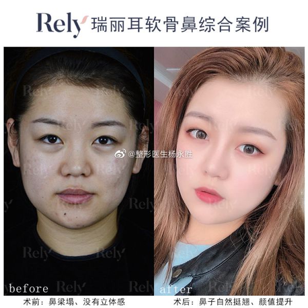 哈尔滨杨永胜和黄志祥哪个医生隆鼻技术好?杨永胜和黄志祥口碑谁好?