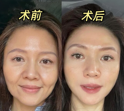 成都姚佳宝做眼周抗衰技术怎么样?姚佳宝做眼部年轻化口碑好吗?