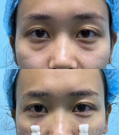 郑州随文文和何永强哪个医生做双眼皮技术好?随文文何永强双眼皮口碑谁好?