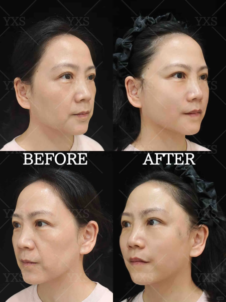 深圳高志文和王乙立做面部提升哪个技术好?谁面部年轻化技术保持时间久?