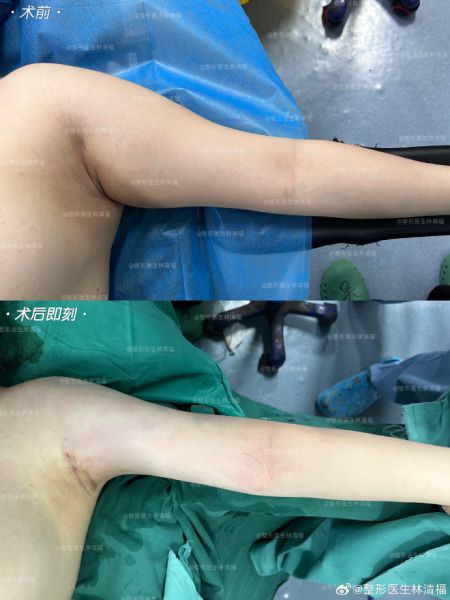 厦门做脂肪专家林清福和王阳明哪个医生吸脂好?