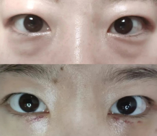 北京卜虹森和于燕祛眼袋这两个医生哪个最好?卜虹森和于燕祛眼袋预约咨询