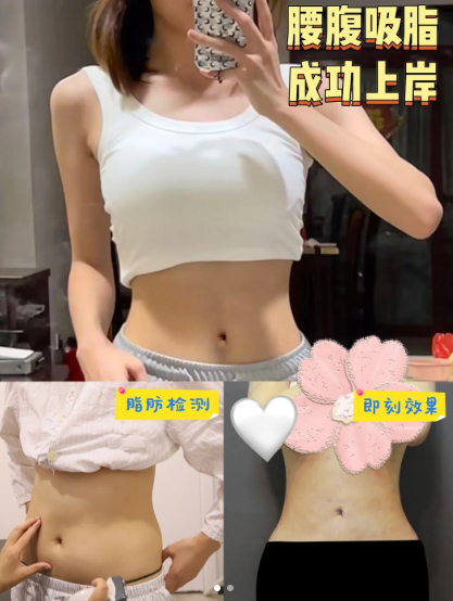 成都吸脂哪个医生做得好?赵善军、郑方荣、王欣、李祥彬、赵善军谁吸脂最好?